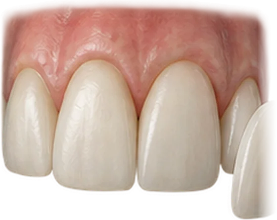 Faceta de porcelana, lâmina fina, ao lado dos dentes da frente