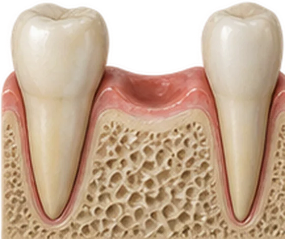Espaço de um dente ausente entre dois dentes