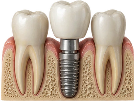 Implante dentário em corte, entre dois dentes naturais: coroa, pilar e implante dentro do osso
