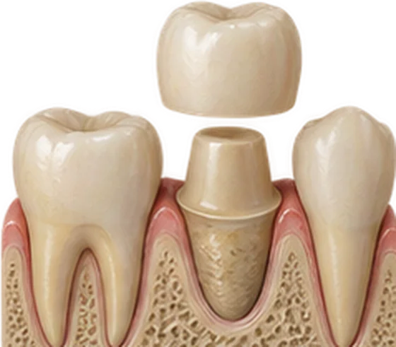 Coroa de porcelana sendo encaixada sobre um dente preparado, entre dois dentes naturais